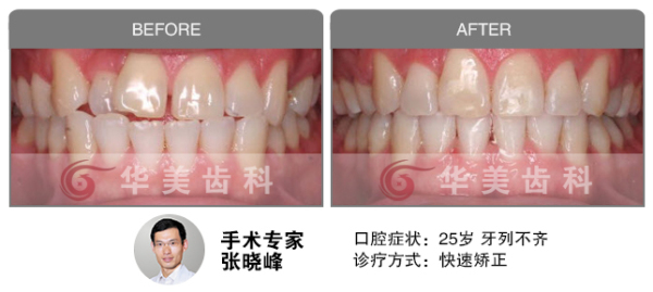 快速矫正治疗牙齿不齐案例对比图